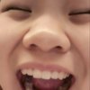 蒜头鼻